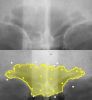 X-ray sinus