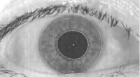 iris not round